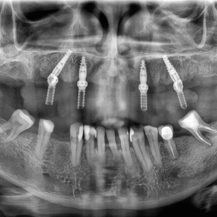 A panoramic radiographic image showing planned implant placement.