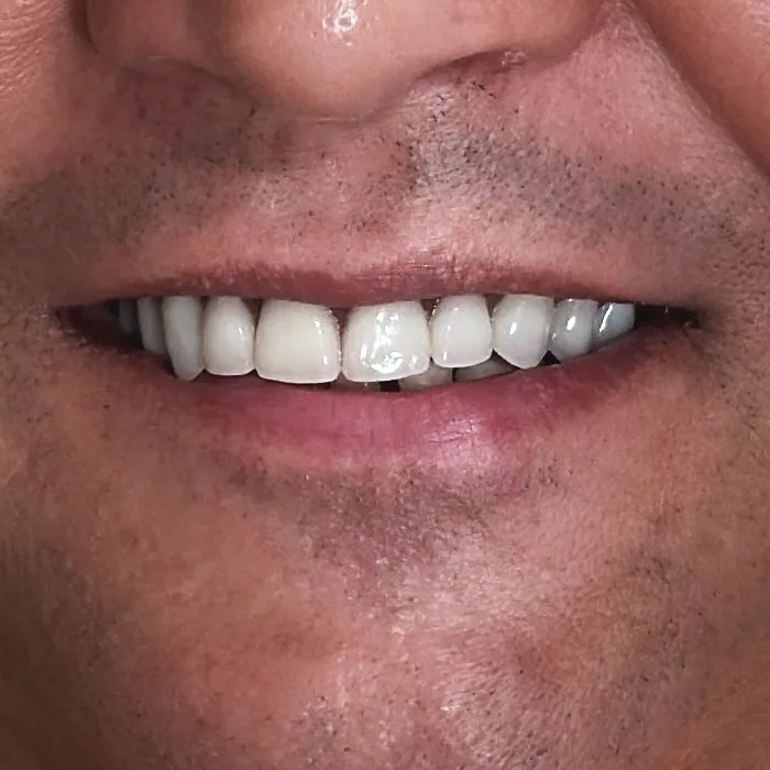 Postoperative photo of a patient's dental implants.