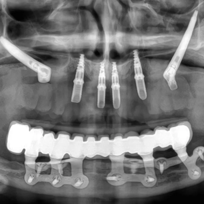 A panoramic radiographic image showing planned implant placement.